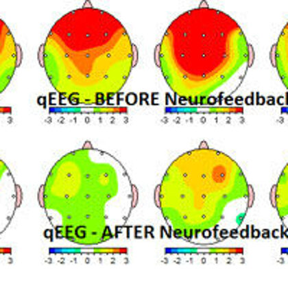 MAPEO NEUROFEEDBACK