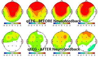 MAPEO NEUROFEEDBACK